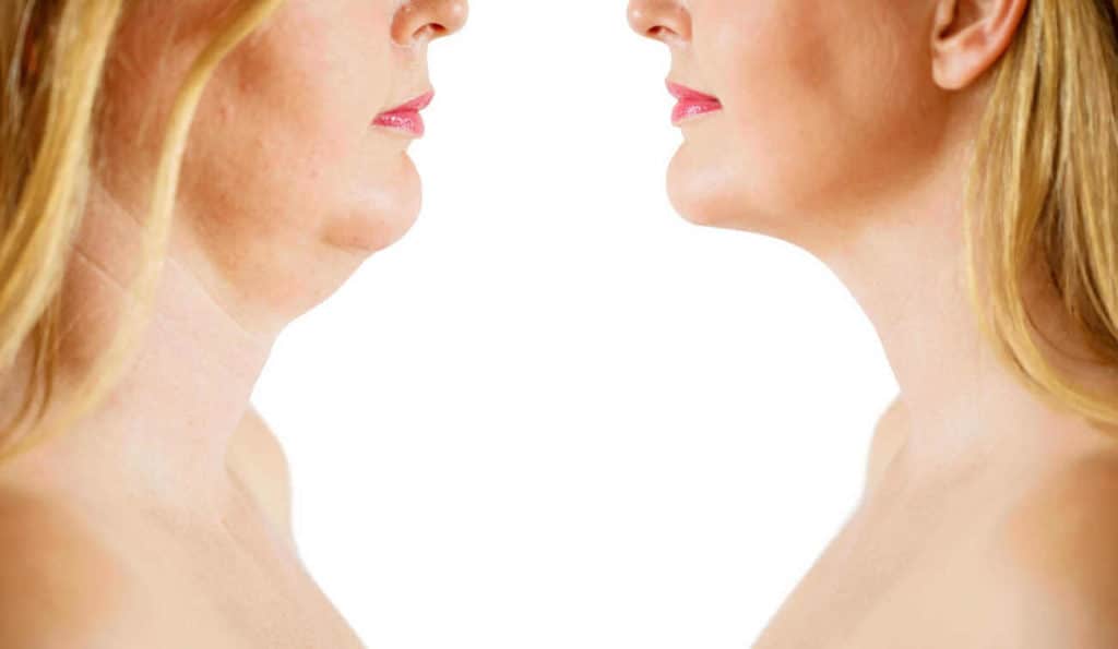 Double Chin treatment Broxburn before and after results