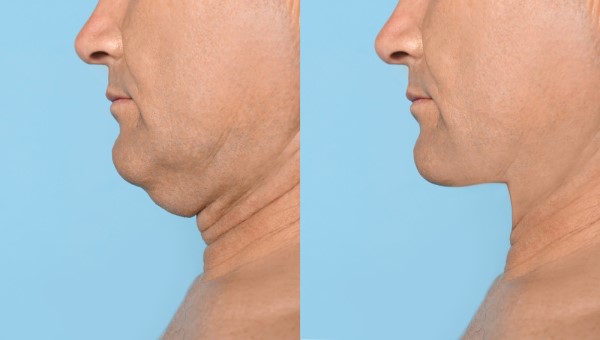 Which Non-Surgical Treatments Work Best for Jowls and Loose Skin Broxburn?