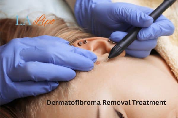 Dermatofibroma Removal Treatment Broxburn