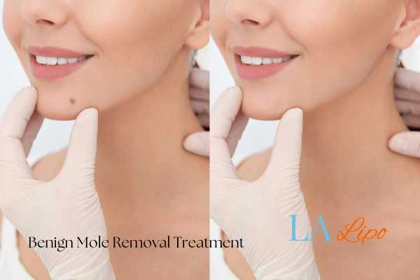 woman's before and after mole removal Broxburn results