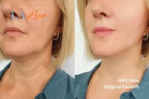 hi-fu for wrinkles Broxburn before and after results