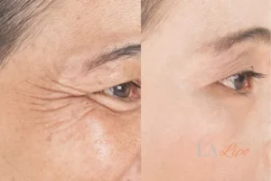 Before and after results of woman - HI-fu wrinkles reduction treatment Broxburn