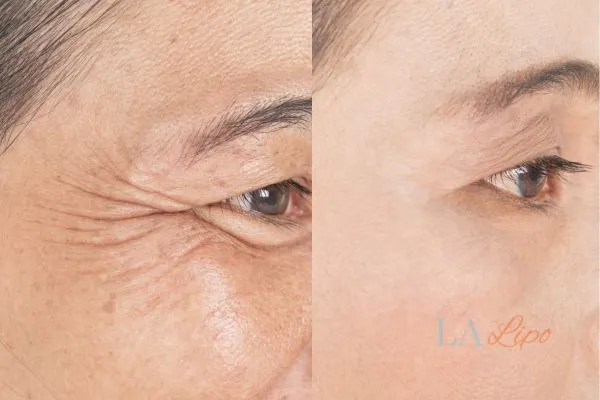 Before and after results of woman - HI-fu wrinkles reduction treatment Broxburn