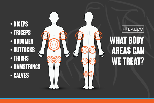Graphic to show areas you can have LA-EMS Body Sculpting Broxburn treatment.