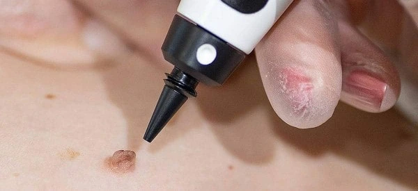 skin tag removal using cryopen Broxburn