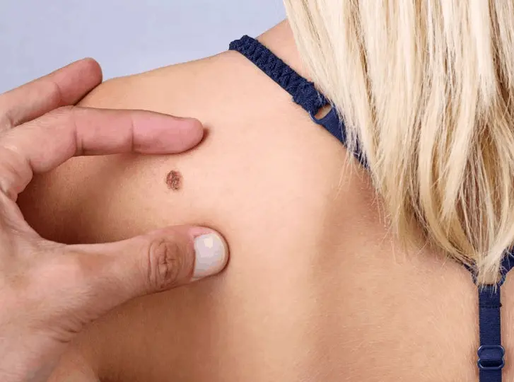woman having mole removal Broxburn consultation before treatment.