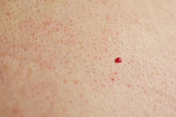 close up of a cherry angioma Broxburn