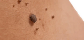 image of a skin tag Broxburn