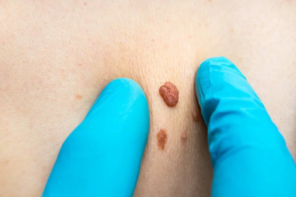 Consultant examining a skin tag Broxburn