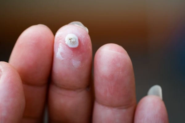 wart on person finger - cryotherapy to treat from LA LIPO Broxburn
