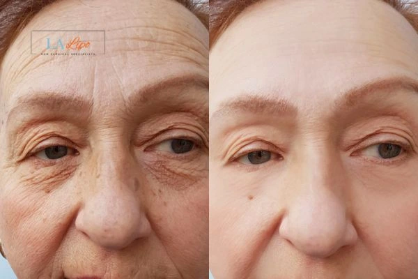 The powerful benefits of Morpheus8 Treatment Broxburn - Call Our team today!