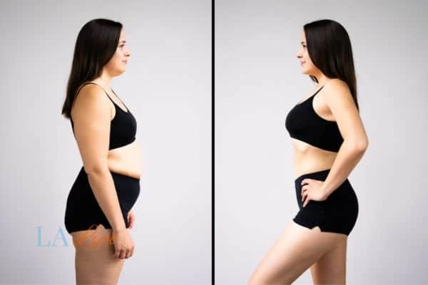 Picture of womans before and after using LA-EMS body sculpting to improve her core strength Broxburn