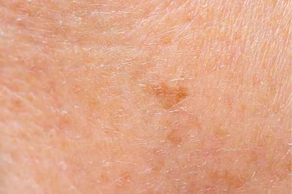 close up picture of age spots Broxburn