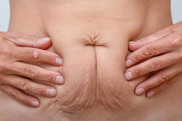 Image of a woman's stomach with loose skin - example of skin tightening Broxburn options