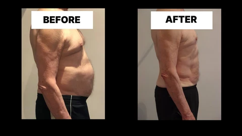 What Symptoms Can Diastasis Recti Cause in Men? Weak Core, Back Pain and Poor Posture Broxburn